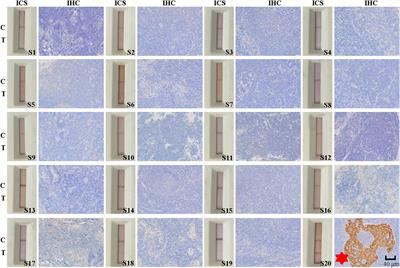 Development of a Colloidal Gold Immunochromatographic Strip for Rapid Detection of Cyfra 21-1 in Lymph Node Metastasis of Thyroid Cancer